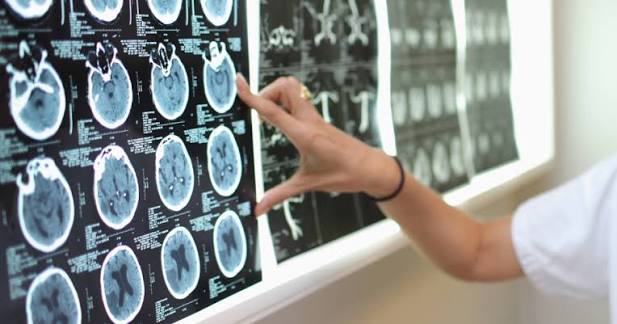 Troubles cognitifs après AVC